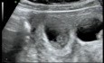 Réduction embryonnaire par voie transvaginale - Grossesse quadruple