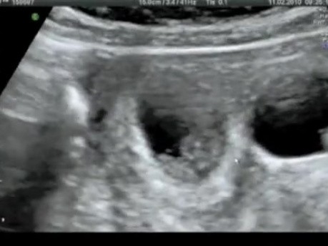 Réduction embryonnaire par voie transvaginale - Grossesse quadruple
