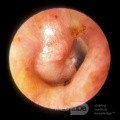 Adénome primaire de l'oreille moyenne