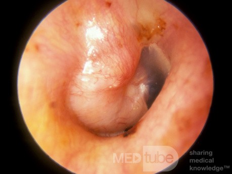 Adénome primaire de l'oreille moyenne