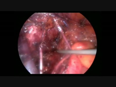 Lésion du nerf obturateur lors de l'hystérectomie totale par voie laparoscopique