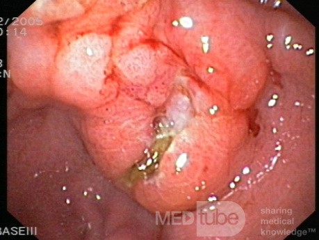  Le lymphome gastrique - vue ensocopique.