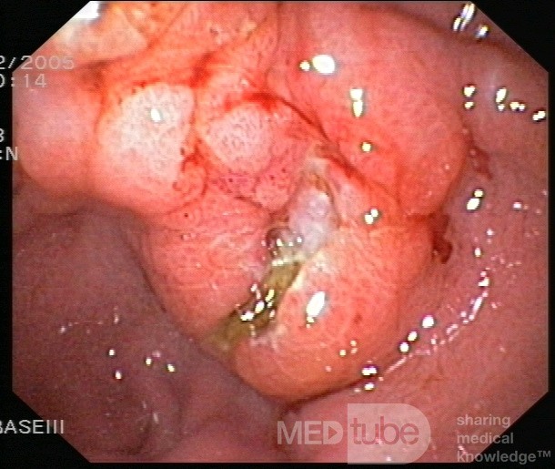  Le lymphome gastrique - vue ensocopique.