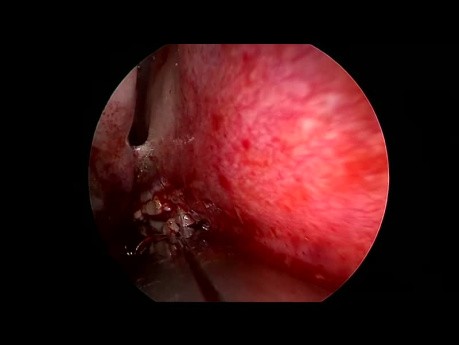 Réparation Endoscopique de l'Atrésie des Choanes 