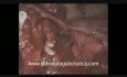 Résection Anatomique de la Lingula par Vidéo-Thoracoscopie Uniportale
