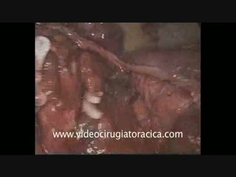 Résection Anatomique de la Lingula par Vidéo-Thoracoscopie Uniportale