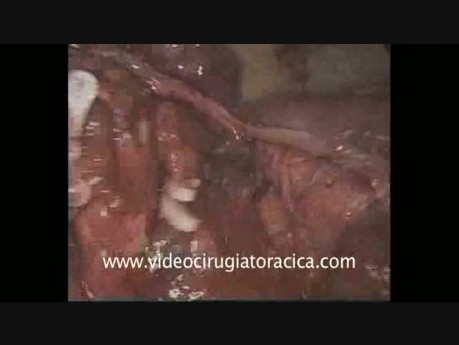 Résection Anatomique de la Lingula par Vidéo-Thoracoscopie Uniportale