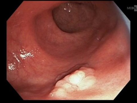 L'Extrémité Prédécoupée de l'Anse pour la Mucosectomie comme alternative à la Dissection Sous-Muqueuse Endoscopique (ESD)
