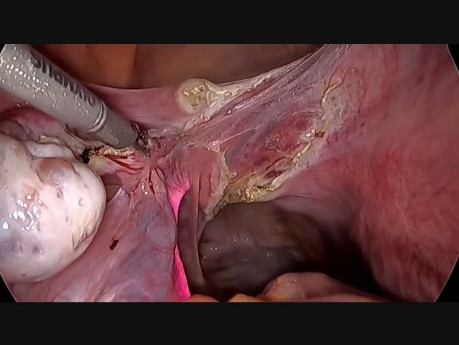 TLH avec stenting de l'uretère à Nellore