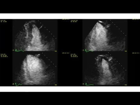 Échocardiographie d'Effort - Principes d'Evaluation de l'Ischémie et Cas Cliniques