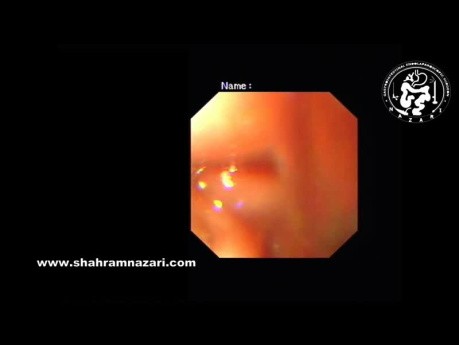 Diverticule Oesophagien dans un Cas d'Achalasie