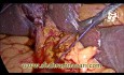 Cholécystectomie laparoscopique / Exploration LCBD et Cholédochoduodénostomie