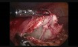 Prise en charge laparoscopique du kyste hydatique
