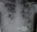 La radiographie du thorax