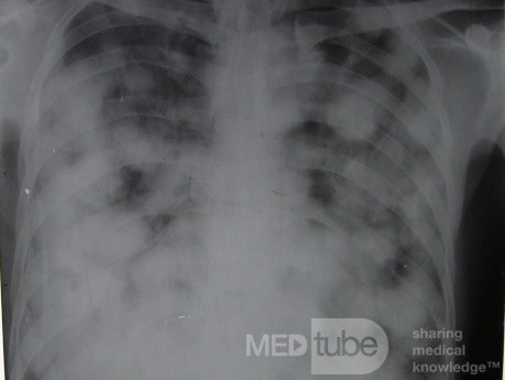 La radiographie du thorax