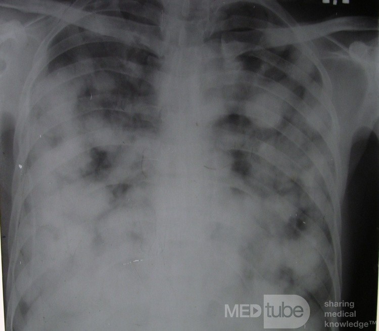 La radiographie du thorax