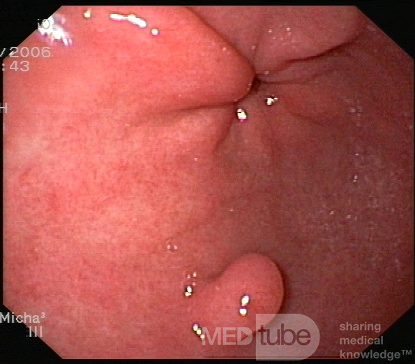 Le polype hyperplasique cardia du cardia.