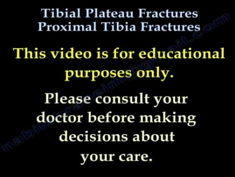 Fractures du plateau tibial / Fractures du tibia proximal