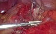 Appendicectomie Rétrograde Laparoscopique avec Pose d'Agrafes