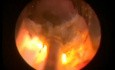Sténose urétrale - Photovaporisation au laser Greenlight