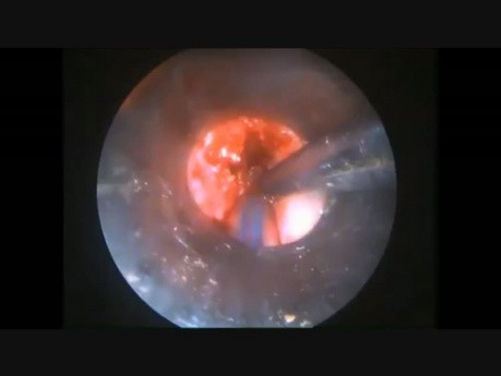 Excision endoscopique de la tumeur transglottique 2