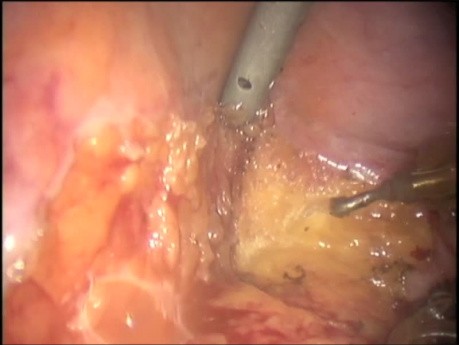 Procédure de retrait colo-anal robotique - Bassin masculin difficile