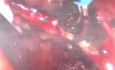 Chirurgie Transanale Utilisant la Technique GelPoint Path. Premier Cas au Brésil.