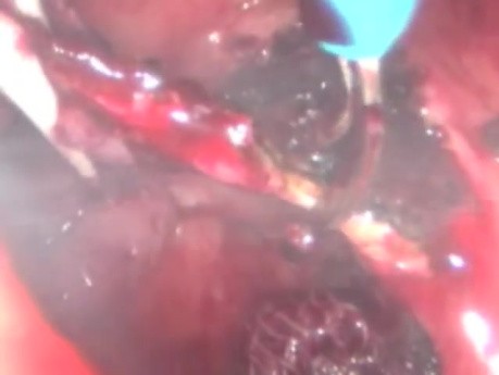 Chirurgie Transanale Utilisant la Technique GelPoint Path. Premier Cas au Brésil.
