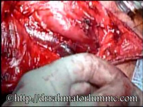 Ligature de la veine jugulaire interne