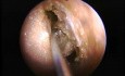 Ethmoïdectomie antérieure - Endoscopie