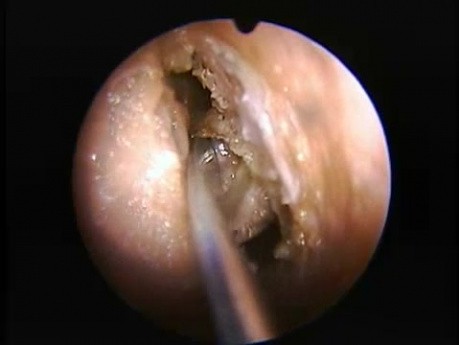 Ethmoïdectomie antérieure - Endoscopie