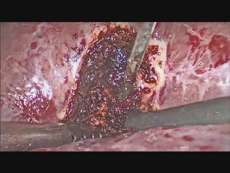 Drainage laparoscopique de l'abcès hépatique