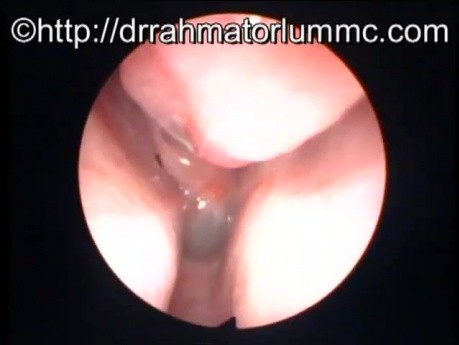 Polype Antrochoanal Droit