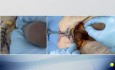 OrthoApproche - Abord de la Symphyse Pubienne - Incision de Pfannenstiel