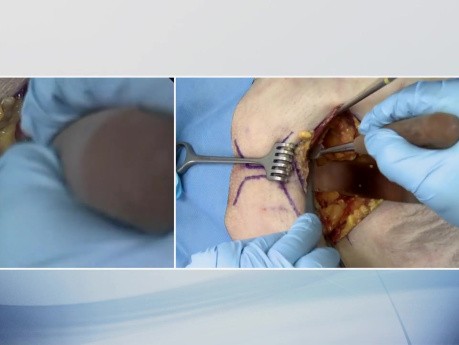 OrthoApproche - Abord de la Symphyse Pubienne - Incision de Pfannenstiel