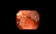 Clip au-dessus de l'endoscope pour la fermeture de la fistule de gastrectomie en manchon