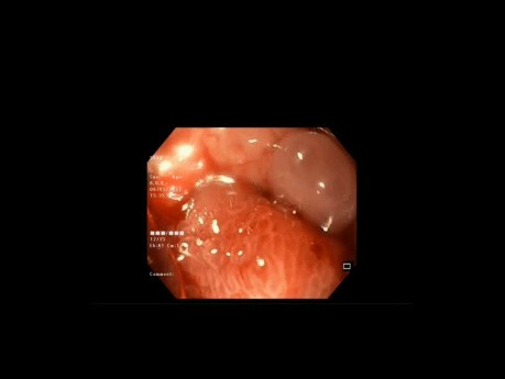 Clip au-dessus de l'endoscope pour la fermeture de la fistule de gastrectomie en manchon