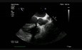 Endocardite infectieuse sur la valve aortique bicuspide