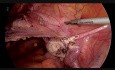 TLH avec stent uretère