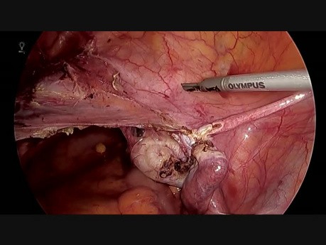 TLH avec stent uretère