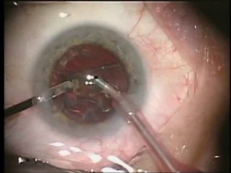 Phacoémulsification - chirurgie de la cataracte