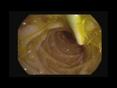 Retrait du stent du canal cholédoque