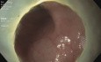 Dissection sous-muqueuse endoscopique (ESD) pour une LST-G colo-rectale