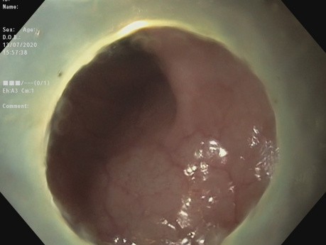 Dissection sous-muqueuse endoscopique (ESD) pour une LST-G colo-rectale