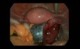 Kystectomie laparoscopique et une torsion d'annexe
