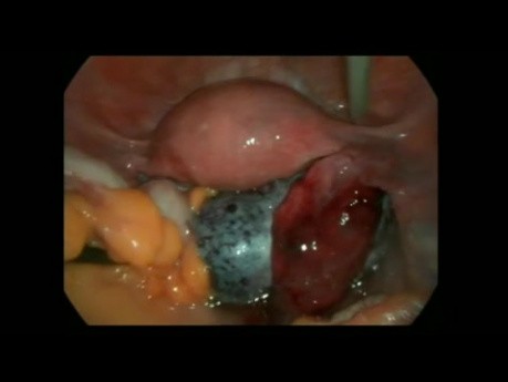 Kystectomie laparoscopique et une torsion d'annexe