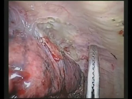 Lobectomie par VATS avec Résection du Lobe Inférieur et de la Paroi Thoracique