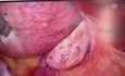 Myomectomie vNOTES 