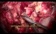 Microchirurgie d'un Large Schwannome du Trijumeau (Division Ophtalmique V1)