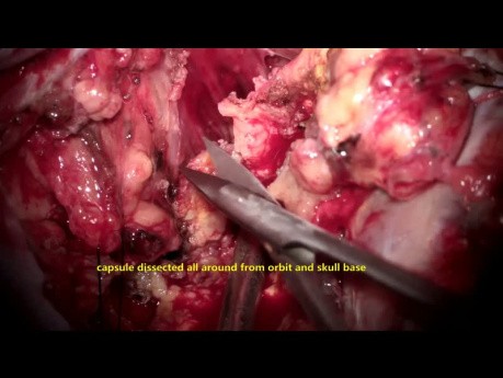Microchirurgie d'un Large Schwannome du Trijumeau (Division Ophtalmique V1)